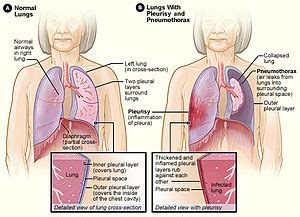 A sharp pain on the right side where my ribs are, it turned out to gas! Pleurisy - Wikipedia