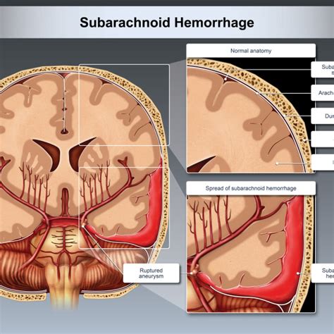 Subarachnoid Hemorrhage Coronal Cut Away View Trialexhibits Inc Gambaran