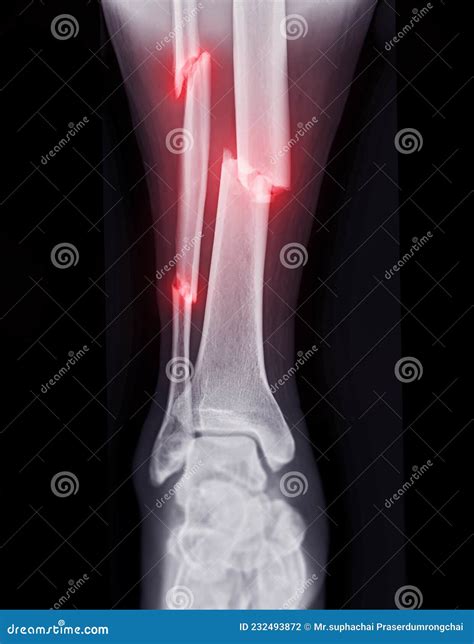 X Ray Image Of Ankle Joint Showing Fracture Tibia And Fibula Bone Stock
