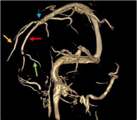 Anatomic Variation Of Superior Sagittal Sinus Oblique 3d Phase