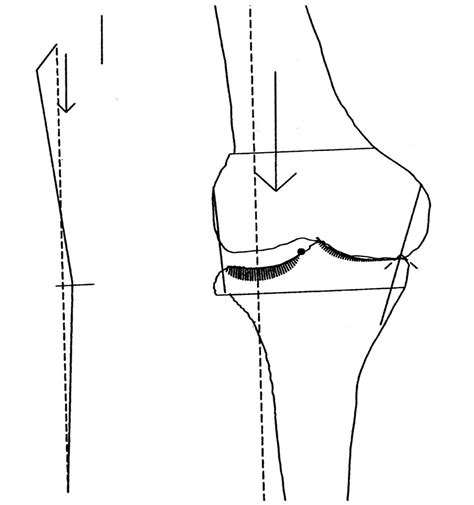 Double Level Osteotomy Of The Knee A Method To Retain Joint Jbjs