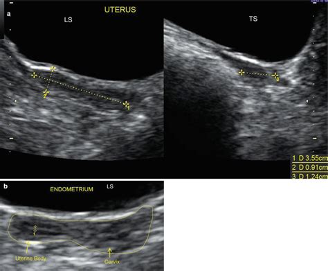 Ultrasound Evaluation Of Myometrium Obgyn Key
