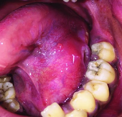 Ulcer On Floor Of Mouth