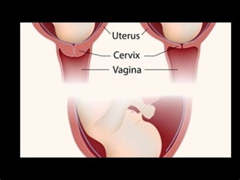 Way To Open Cervix During In Labor YouTube