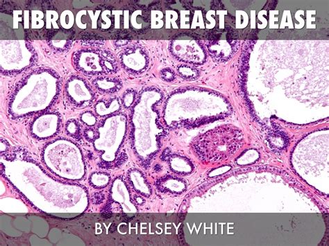 Fibrocystic Breast Disease By Chelsey White