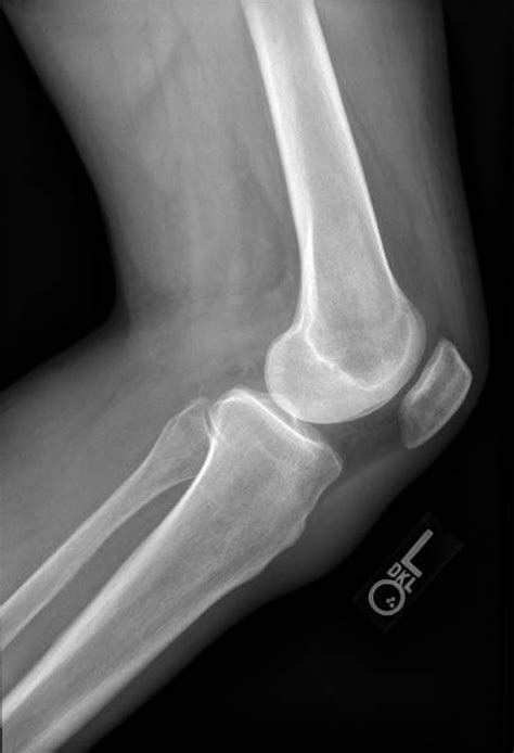 This showed a dislocated proximal tibiofibular joint on the right side (fig. Normal Knee X-Ray: 3 View - JETem