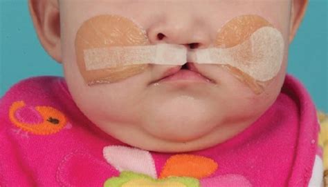 Dentists Evolving Role In Treating Cleft Lip And Palate Decisions In