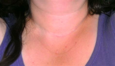 My Thyroid Journey Scar Progress Pics