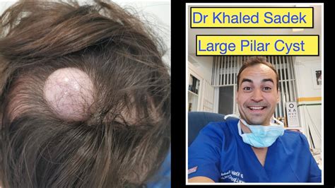 Pilar Cyst Removal Live Dr Khaled Sadek Youtube