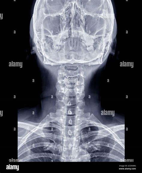 X Ray C Spine Or X Ray Image Of Cervical Spine Ap View For Diagnostic