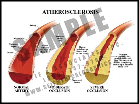 Atherosclerosis Sanda Medical Graphics