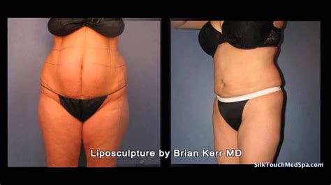 Smartlipo Laser Lipo On Female Abdomen Before And After Photos By
