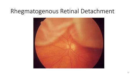 Retinal Detachment Associated Vitreoretinal And Uveitis Consultants
