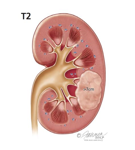 Renal Mass And Localized Renal Tumors Symptoms Diagnosis Treatment