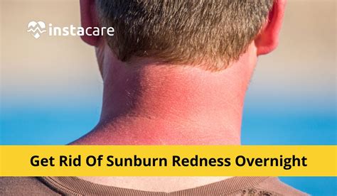 How To Get Rid Of Sunburn Redness Overnight 5 Home Remedies
