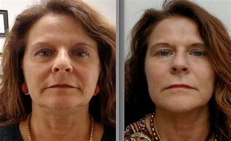 The Profound Non Surgical Face Lift Forever Young