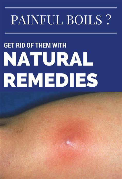 Painful Boils Get Rid Of Them With Natural Remedies Natural Remedies