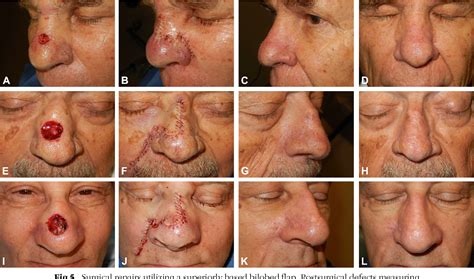 The Superiorly Based Bilobed Flap For Nasal Reconstruction Semantic