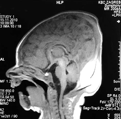 Mri Of The Skull Occipital Bone Fracture With Epidural And Subdural