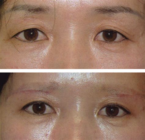 Eyelid Surgery By Prof Dr Cn Chua 蔡鐘能 Doctor Could You Lift My