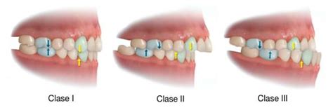 Maloclusión Clase 1 Características Causas Y Tratamiento