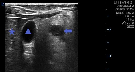 Identifying Retrocecal Appendicitis On Point Of Care Ultrasound Pocus
