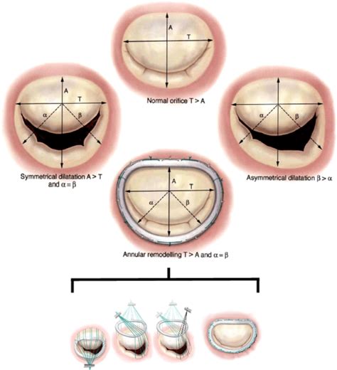 Mitral