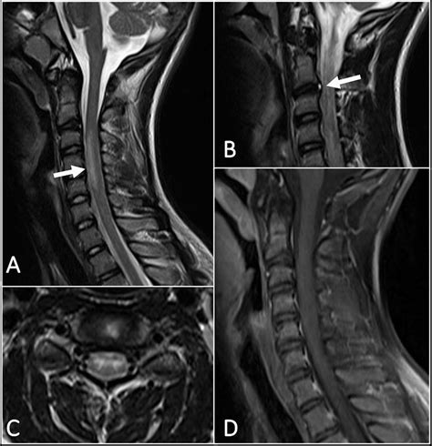 Cureus Spinal Cord Infarct Due To Fibrocartilaginous Embolism In An