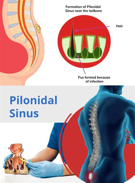 Pilonidal Sinus Endoscopic Pilonidal Sinus Treatment Dr Chowbey