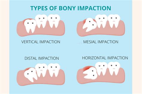 Impacted Wisdom Tooth Everything You Should Know And Do