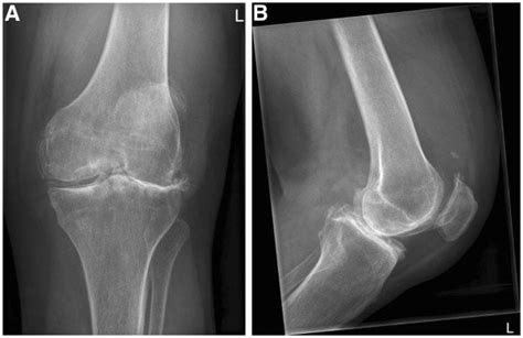 An X Ray Of The Left Knee Showed Severe Osteoarthritis With Evident