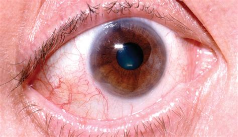 Lymph Node Clues To Conjunctivitis The Clinical Advisor