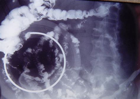 Small Bowel Tumor Carcinoid 3996 Pictures 015 Surgery Photos