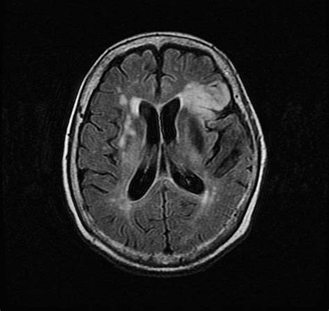 Diffusion Weighted Magnetic Resonance Imaging Study Showed High Signal