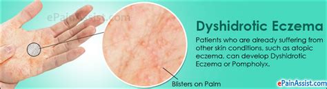 Dyshidrotic Eczema Or Pompholyx Treatment Home Remedies Causes