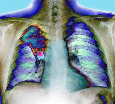 Lung Cancer X Ray Photograph By Du Cane Medical Imaging Ltd Fine Art