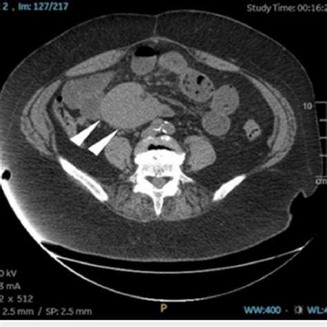Ct Of The Abdomen And Pelvis Without Contrast Supine Position Axial