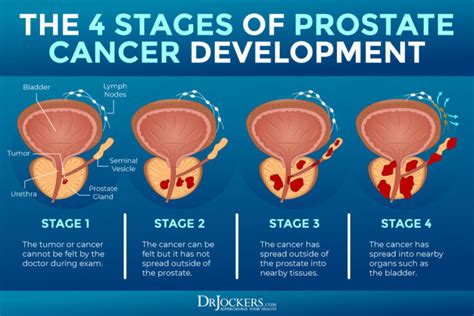 Prostate Cancer Symptoms Causes And Support Strategies