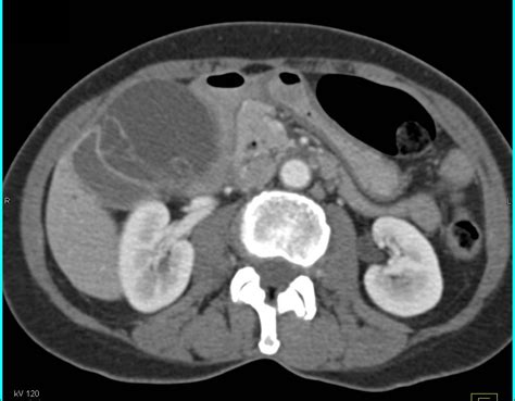 Gallbladder Abscess Liver Case Studies Ctisus Ct Scanning