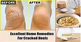 Heal Cracked Heels Home Remedies Pictures