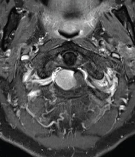 A T2 Weighted Sagittal Mri Of The Cervical Spine Showed A Tumor In