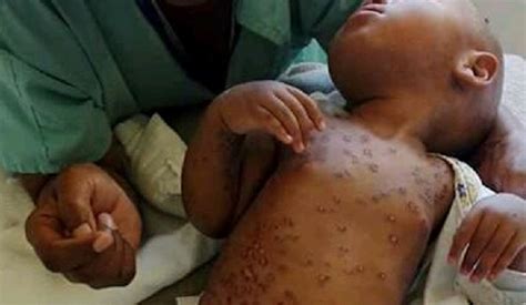1 shortly after, the advisory committee on immunization practices (acip) issued an interim recommendation for its use. MMR Vaccine Side Effects | Children In Africa Get Rashes ...