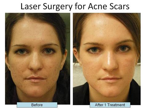 Acne Scar Treatments Nyc Schweiger Dermatology
