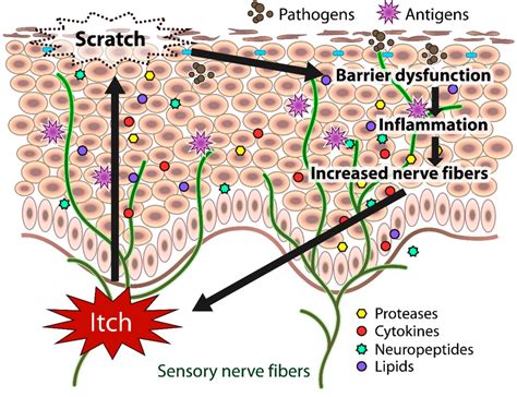 Schematic Representation Of Chronic Itch In Atopic Dermatitis