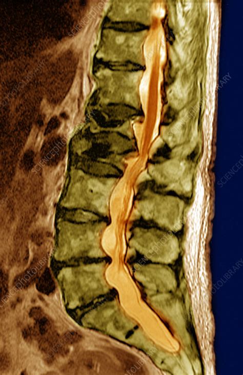 Lumbar Compression Fracture Mri Stock Image C Science