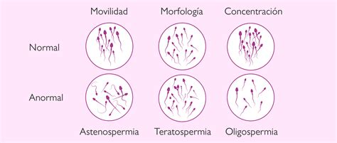 Qu Es El Seminograma Y Cu Ndo Se Considera Normal