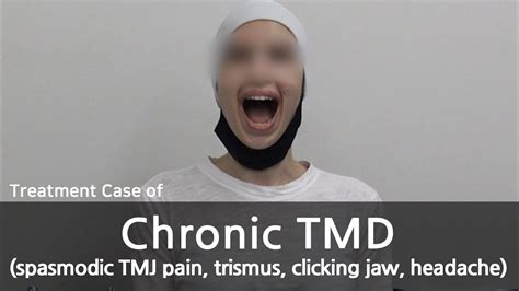 Chronic Tmd Spasmodic Tmj Pain Trismus Clicking Jaw 만성턱관절장애