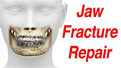 Jaw Fracture Surgical Treatment Animation MMF ORIF YouTube