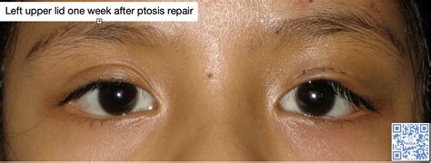 Congenital Ptosis Roque Eye Clinic Ph