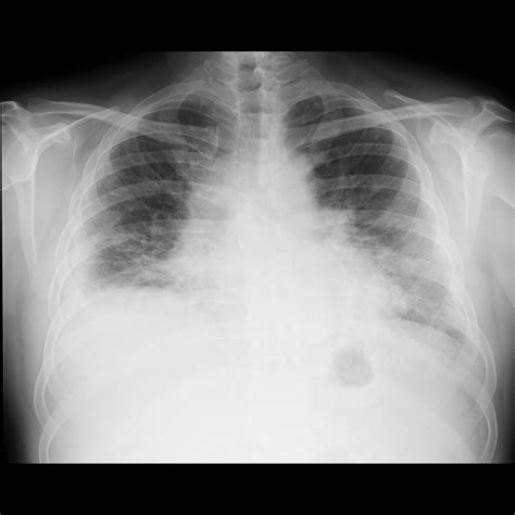 Pulmonary Edema Chest X Ray